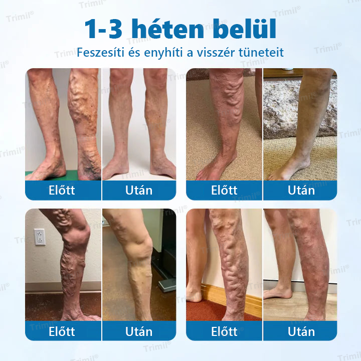 đTrimilÂź VeinGuard GyĂłgynövĂ©nyes Sprayđ - Klinikailag bizonyĂtott, hogy mindössze 7 nap alatt megszĂŒnteti a visszereket!âš