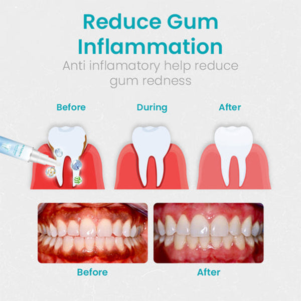 đ„Last Day Promotion 80% OFF-NESLEMYâą Gum Shield Therapy Gel