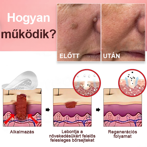 KUBOZN® Nano-mikrotűs bórcímke-eltávolító tapaszok
