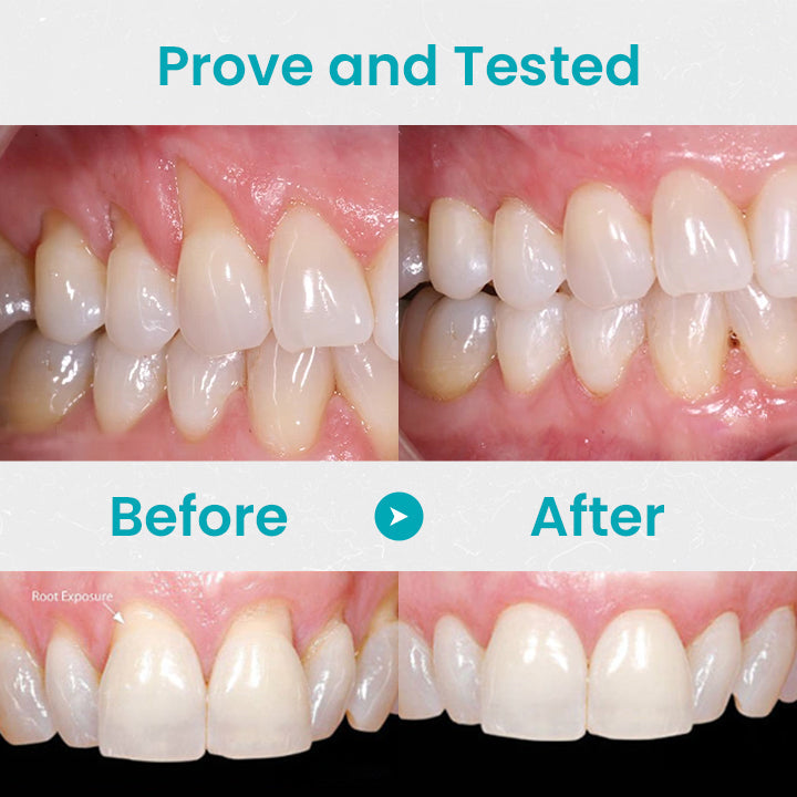 đ„Last Day Promotion 80% OFF-NESLEMYâą Gum Shield Therapy Gel