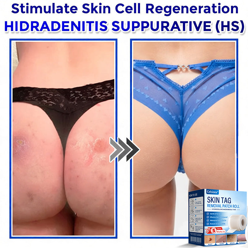 💧🍣Celsiora® Multi-Functional Microneedle Hydrocolloid Patch Roll | Targets Skin Tags, Warts & Stubborn Blemishes