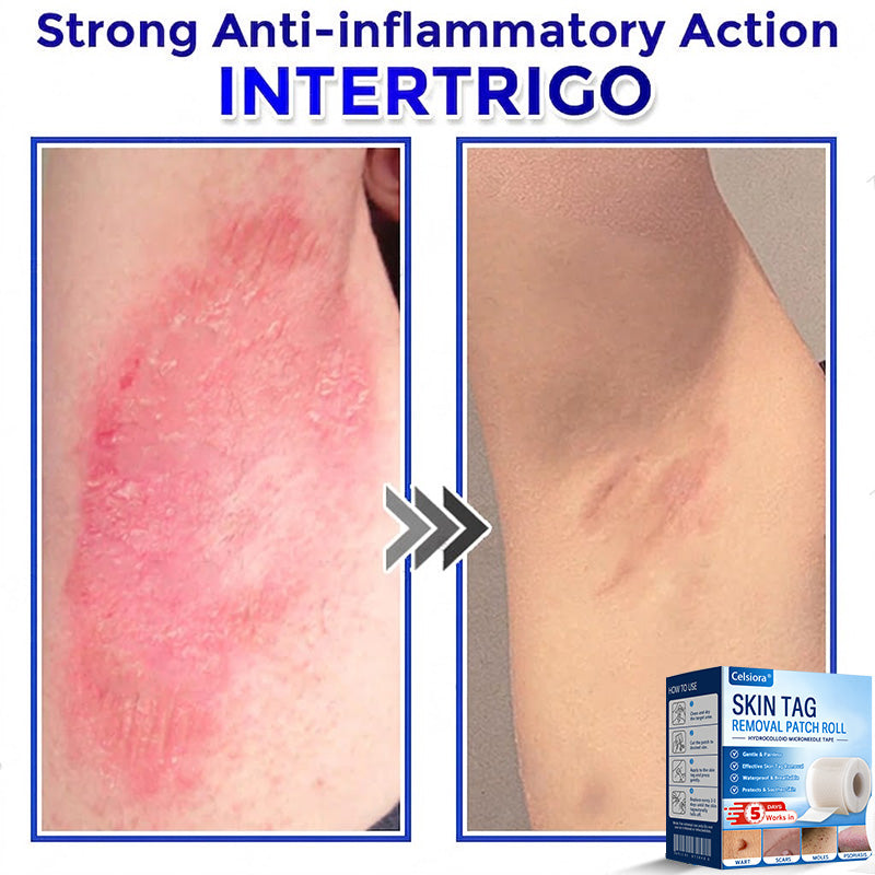 💧🍣Celsiora® Multi-Functional Microneedle Hydrocolloid Patch Roll | Targets Skin Tags, Warts & Stubborn Blemishes