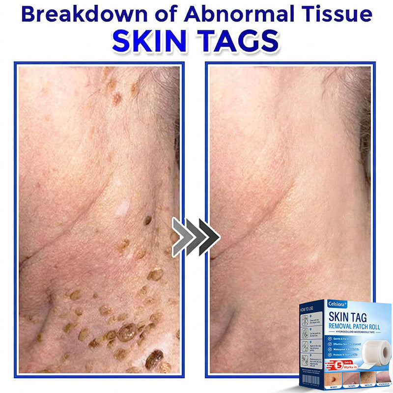 💧🍣Celsiora® Multi-Functional Microneedle Hydrocolloid Patch Roll | Targets Skin Tags, Warts & Stubborn Blemishes