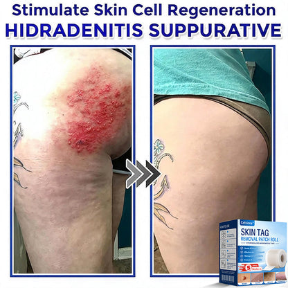 💧🍣Celsiora® Multi-Functional Microneedle Hydrocolloid Patch Roll | Targets Skin Tags, Warts & Stubborn Blemishes