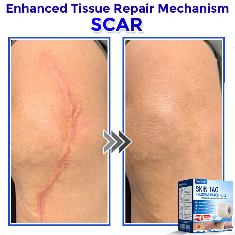 💧🍣Celsiora® Multi-Functional Microneedle Hydrocolloid Patch Roll | Targets Skin Tags, Warts & Stubborn Blemishes