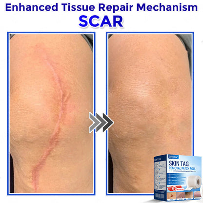 💧🍣Celsiora® Multi-Functional Microneedle Hydrocolloid Patch Roll | Targets Skin Tags, Warts & Stubborn Blemishes