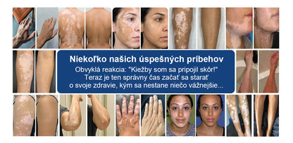 🌿🌿Laleia® Piperín Repigmentačný aktivačný sprej