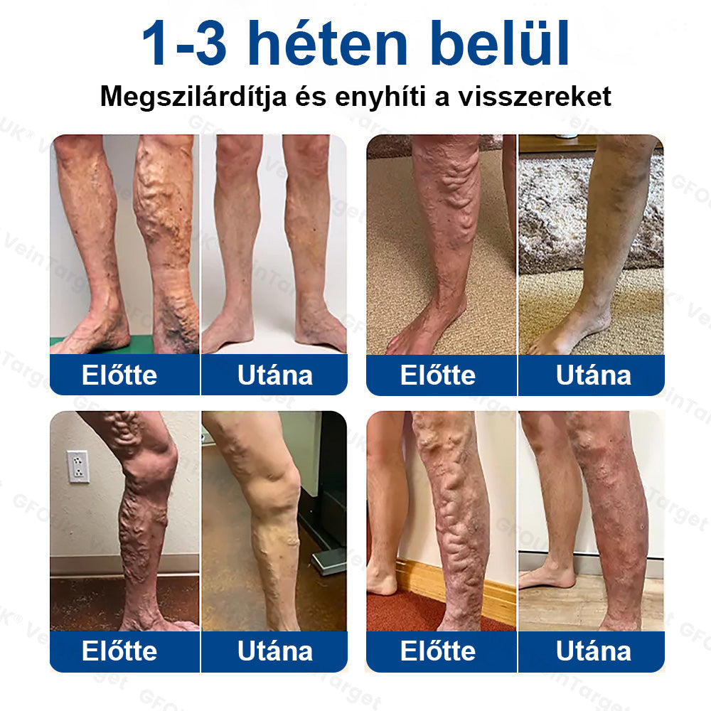 ✅✅✅Laleia® Vein Ease mikrotűs tapasz
