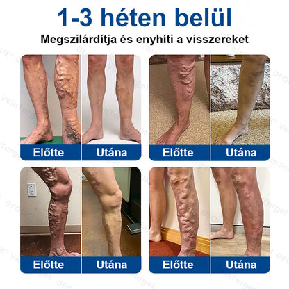 ✅✅✅Laleia® Vein Ease mikrotűs tapasz