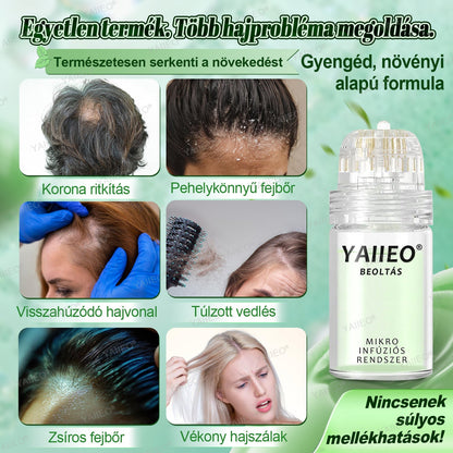 🍍𝐘𝐀𝐈𝐈𝐄𝐎® 𝑭á𝒋𝒅𝒂𝒍𝒐𝒎𝒎𝒆𝒏𝒕𝒆𝒔 𝑴𝒊𝒌𝒓𝒐𝒊𝒏𝒇ú𝒛𝒊ó𝒔 𝑹𝒆𝒏𝒅𝒔𝒛𝒆𝒓 Mélyen ható DHT-blokkolás, hajhagymák újraaktiválása és látható hajnövekedés