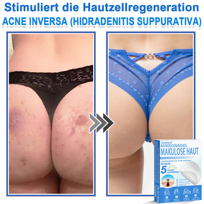 🏆Celsiora® 2-in-1 Mikronadel- & Hydrokolloid-Pflaster | Entferner für erhabene Muttermale, Akne, flache Warzen & Hautanhängsel | Verbessert Falten, Narben & Hautunreinheiten | Unsichtbare Stern-Pickelpflaster für Gesicht & Körper