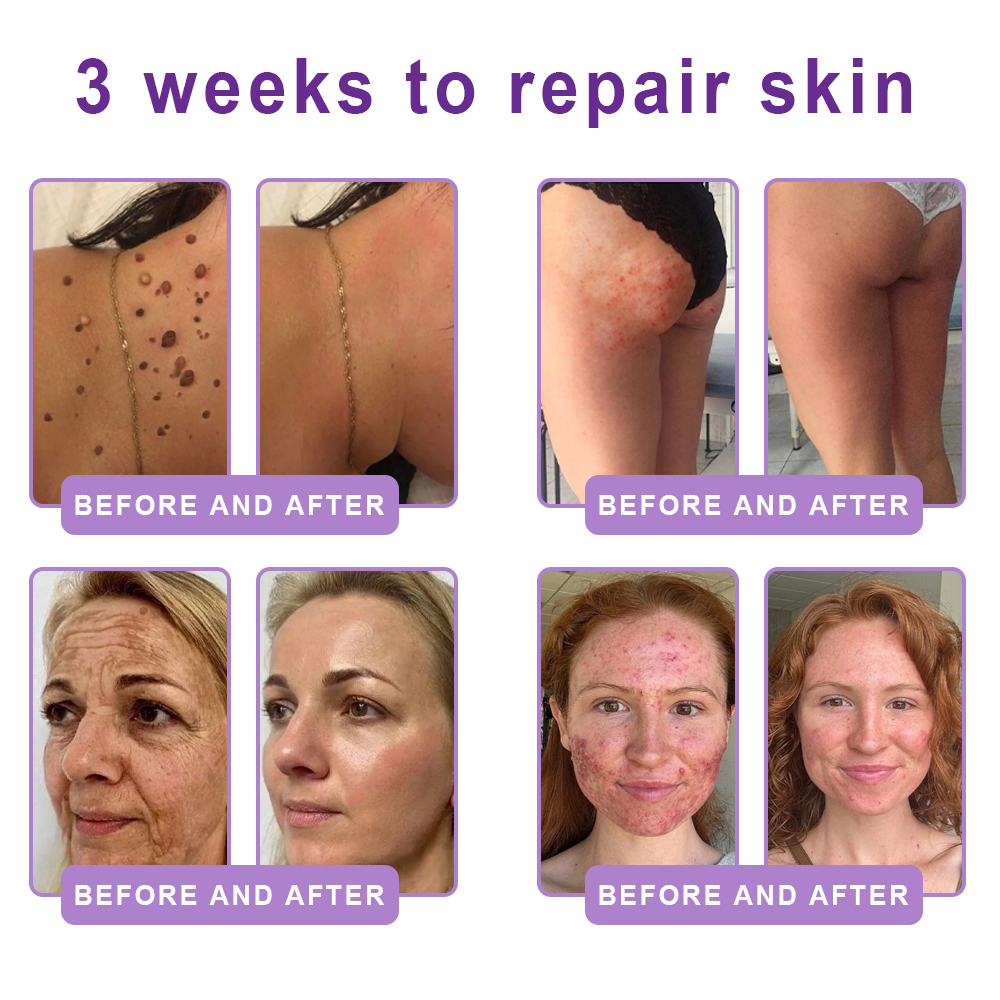 𝐇𝐈𝐒𝐊𝐈𝐍® 𝐏𝐃𝐑𝐍 𝐌𝐮𝐥𝐭𝐢-𝐏𝐞𝐩𝐭𝐢𝐝𝐞 𝐌𝐚𝐬𝐬𝐚𝐠𝐢𝐧𝐠 𝐁𝐨𝐝𝐲 𝐑𝐨𝐥𝐥𝐞𝐫 𝐂𝐫𝐞𝐚𝐦- Anti-aging, Hydrating, Skin Firming & Lifting, Skin Repair, Even Tone, Acne and Dark Spot Treatment, Wart and Mole Removal, and Psoriasis Relief.