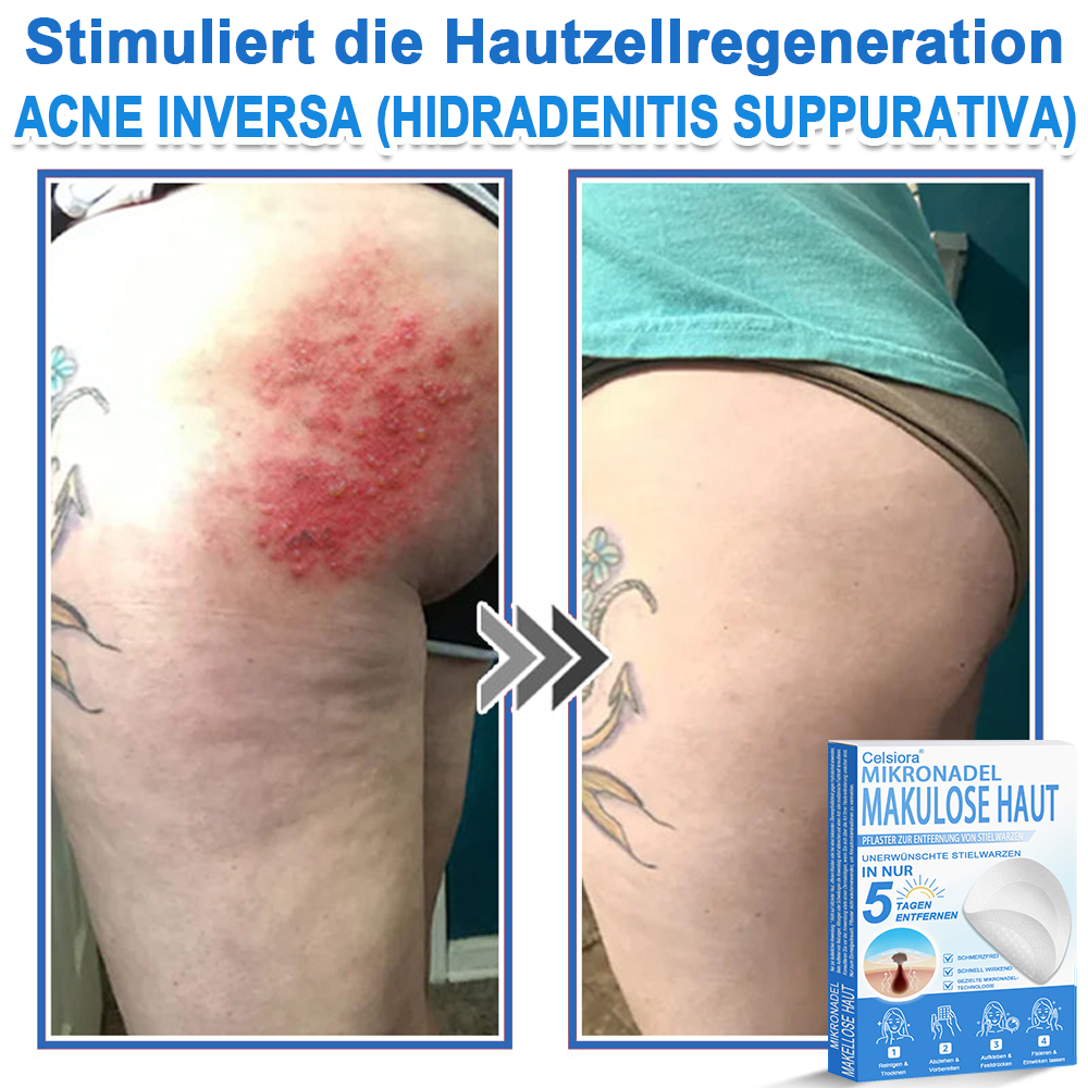 🏆Celsiora® 2-in-1 Mikronadel- & Hydrokolloid-Pflaster | Entferner für erhabene Muttermale, Akne, flache Warzen & Hautanhängsel | Verbessert Falten, Narben & Hautunreinheiten | Unsichtbare Stern-Pickelpflaster für Gesicht & Körper