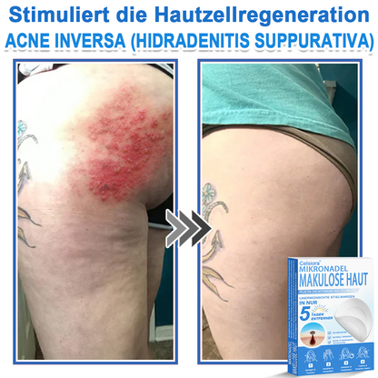 🏆Celsiora® 2-in-1 Mikronadel- & Hydrokolloid-Pflaster | Entferner für erhabene Muttermale, Akne, flache Warzen & Hautanhängsel | Verbessert Falten, Narben & Hautunreinheiten | Unsichtbare Stern-Pickelpflaster für Gesicht & Körper