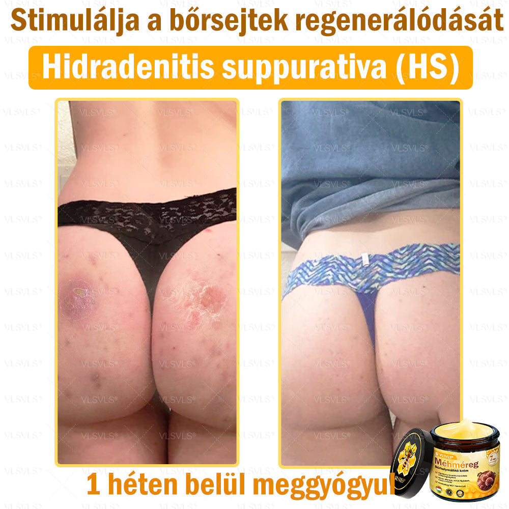 💜💜VLSVLS® Méhméreg Bőrhelyreállító Krém (👨‍⚕‍CE jóváhagyott)👍✅