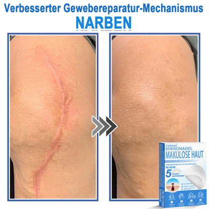 🏆Celsiora® 2-in-1 Mikronadel- & Hydrokolloid-Pflaster | Entferner für erhabene Muttermale, Akne, flache Warzen & Hautanhängsel | Verbessert Falten, Narben & Hautunreinheiten | Unsichtbare Stern-Pickelpflaster für Gesicht & Körper