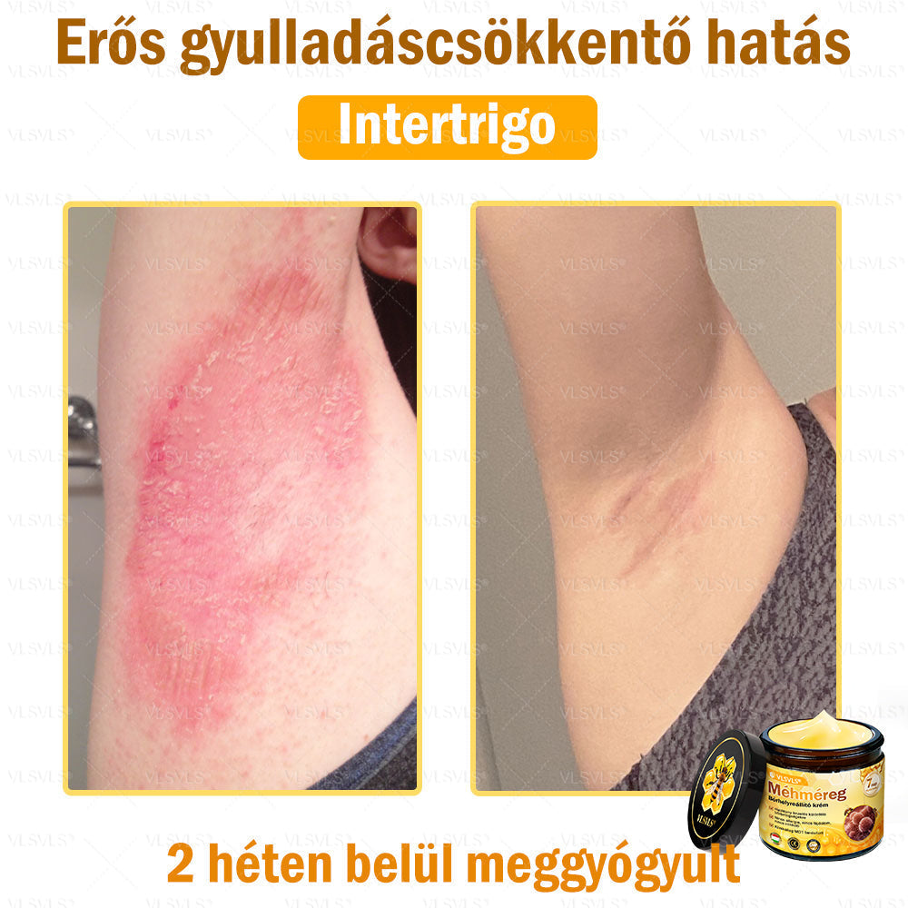 💜💜VLSVLS® Méhméreg Bőrhelyreállító Krém (👨‍⚕‍CE jóváhagyott)👍✅