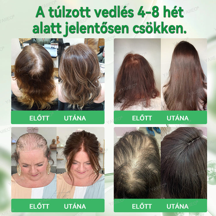 🍍𝐘𝐀𝐈𝐈𝐄𝐎® 𝑭á𝒋𝒅𝒂𝒍𝒐𝒎𝒎𝒆𝒏𝒕𝒆𝒔 𝑴𝒊𝒌𝒓𝒐𝒊𝒏𝒇ú𝒛𝒊ó𝒔 𝑹𝒆𝒏𝒅𝒔𝒛𝒆𝒓 Mélyen ható DHT-blokkolás, hajhagymák újraaktiválása és látható hajnövekedés