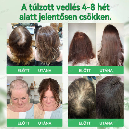 🍍𝐘𝐀𝐈𝐈𝐄𝐎® 𝑭á𝒋𝒅𝒂𝒍𝒐𝒎𝒎𝒆𝒏𝒕𝒆𝒔 𝑴𝒊𝒌𝒓𝒐𝒊𝒏𝒇ú𝒛𝒊ó𝒔 𝑹𝒆𝒏𝒅𝒔𝒛𝒆𝒓 Mélyen ható DHT-blokkolás, hajhagymák újraaktiválása és látható hajnövekedés