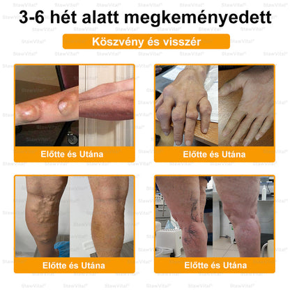 StawVital® Botoxot és Méhmérget Tartalmazó Regeneráló Krém izületekre és Csontokra – MOT (Magyar Ortopéd Társaság) által tanúsított termék