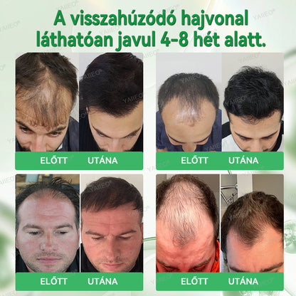 🍍𝐘𝐀𝐈𝐈𝐄𝐎® 𝑭á𝒋𝒅𝒂𝒍𝒐𝒎𝒎𝒆𝒏𝒕𝒆𝒔 𝑴𝒊𝒌𝒓𝒐𝒊𝒏𝒇ú𝒛𝒊ó𝒔 𝑹𝒆𝒏𝒅𝒔𝒛𝒆𝒓 Mélyen ható DHT-blokkolás, hajhagymák újraaktiválása és látható hajnövekedés