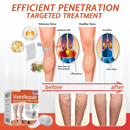 🌿❤️Celsiora® Vein Ease Microneedle Care Patch(For Spider Veins, Varicose Veins, Swelling & Leg Fatigue) - Last Day Promotion 50% OFF
