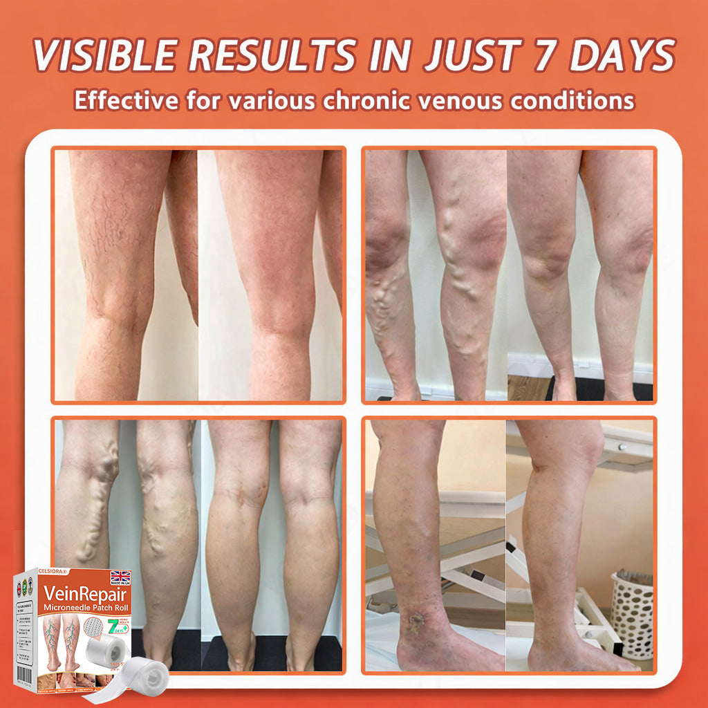 🌿❤️Celsiora® Vein Ease Microneedle Care Patch(For Spider Veins, Varicose Veins, Swelling & Leg Fatigue) - Last Day Promotion 50% OFF