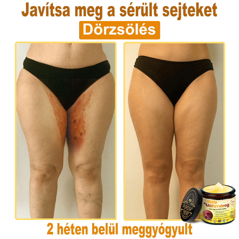 🐝PUROSA® Méhméreg Bőrregeneráló Krém | Teljes körű megoldás makacs bőrproblémákra, például öregedés, ekcéma, hegek és pikkelysömör ellen 🌿✨