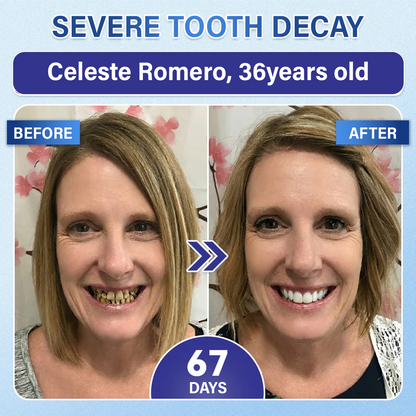 A Te Mosolyod🦷Ceoerty® Fog‑ és Ínyjavító Gyorsan Oldódó Mikrotűs Tapasz✨ (𝟓‑az‑1‑ben 💎 Zománc és Dentin Újraépítése • Ínyek Erősítése • Fogkő és Rossz Szag Megszüntetése • Fogfehérítés • Fogérzékenység Megállítása)