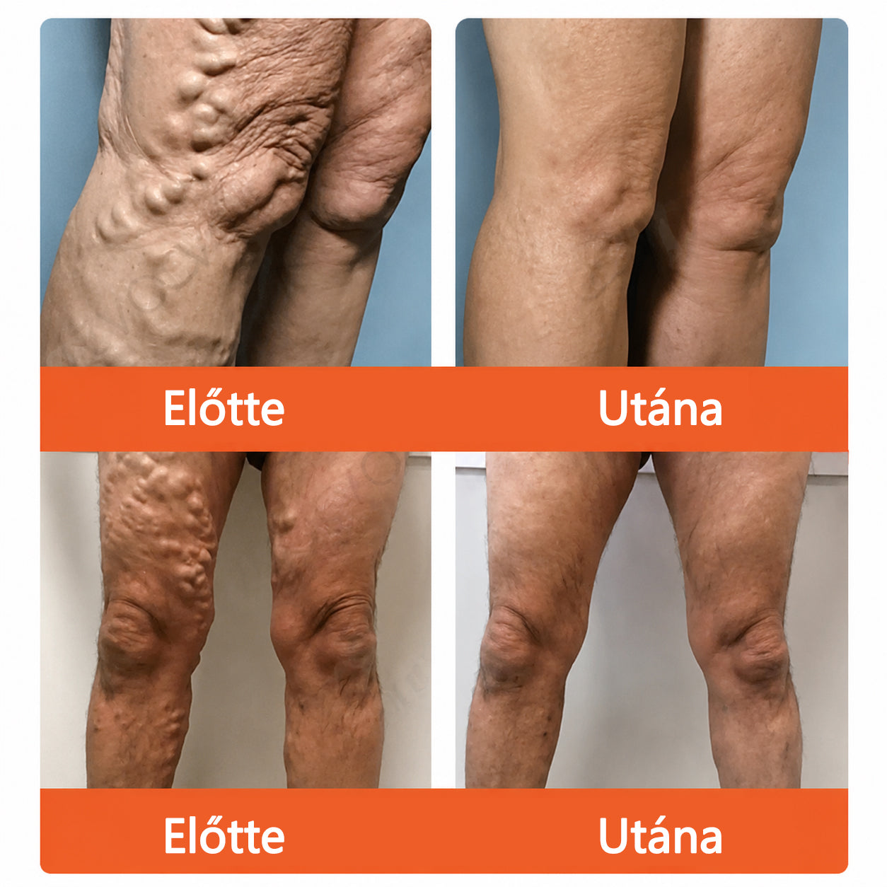 ☘️ Zvoevo® Vein Ease mikro-tűs ápoló tapasz (pókgerincvénák, visszér, duzzanat, fáradt lábak kezelésére)📦