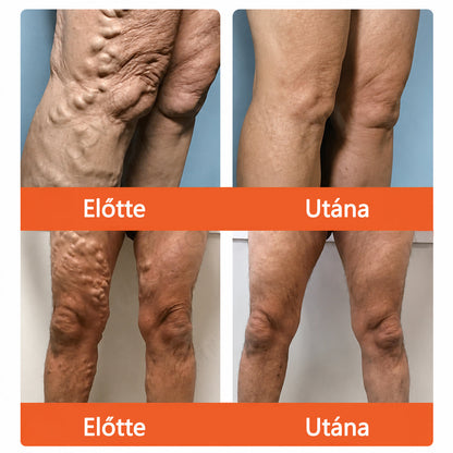 ☘️ Zvoevo® Vein Ease mikro-tűs ápoló tapasz (pókgerincvénák, visszér, duzzanat, fáradt lábak kezelésére)📦