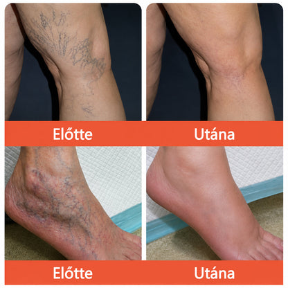 ☘️ Zvoevo® Vein Ease mikro-tűs ápoló tapasz (pókgerincvénák, visszér, duzzanat, fáradt lábak kezelésére)📦