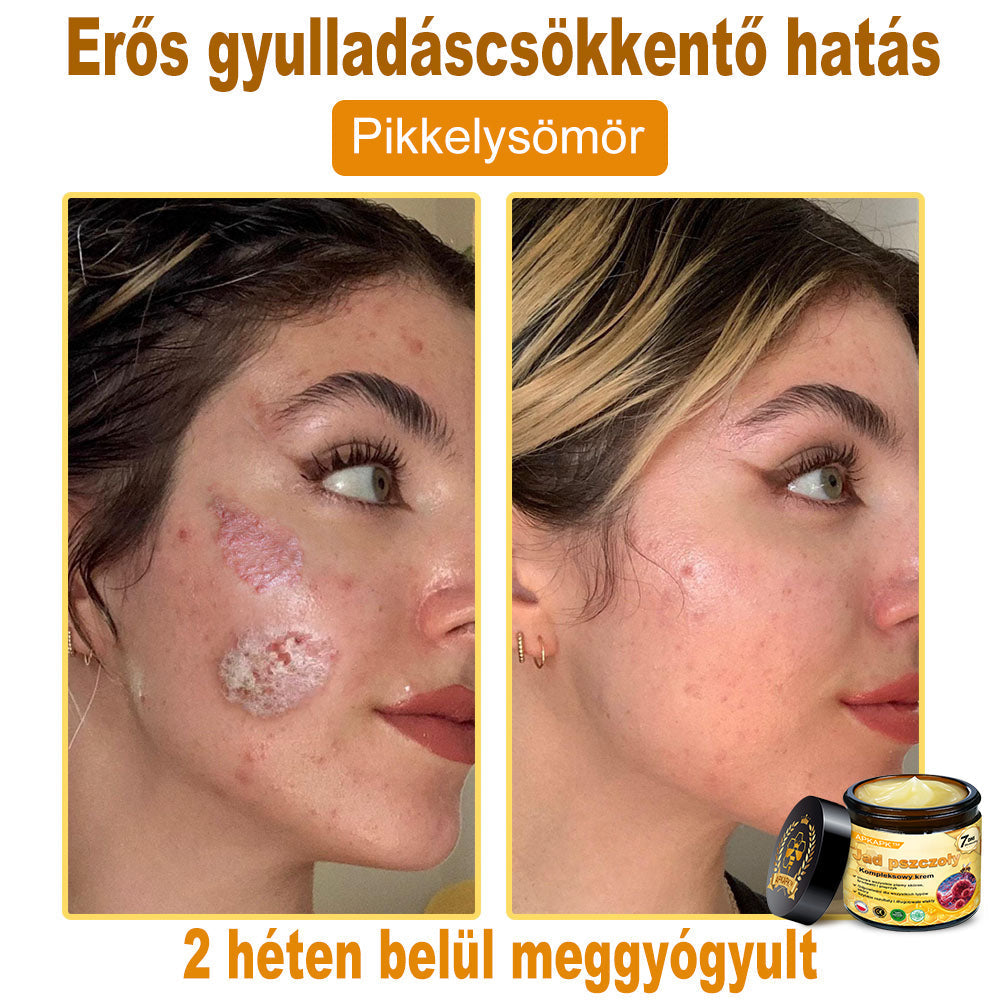 🐝PUROSA® Méhméreg Bőrregeneráló Krém | Teljes körű megoldás makacs bőrproblémákra, például öregedés, ekcéma, hegek és pikkelysömör ellen 🌿✨