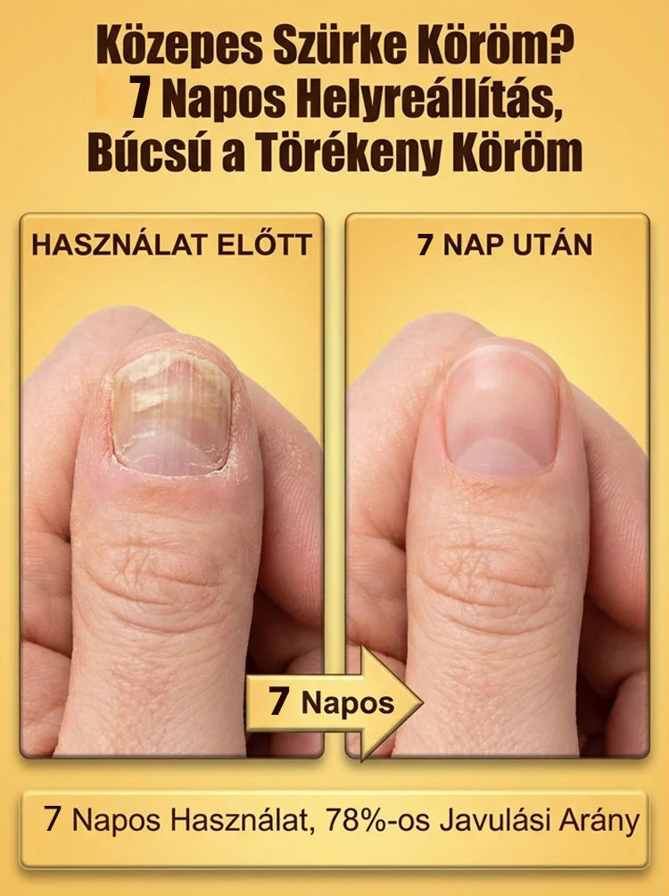 ✨[7 Napos Csodás Körömfényesítés]🐝 Méhméreg Prémium Körömápoló Cseppek