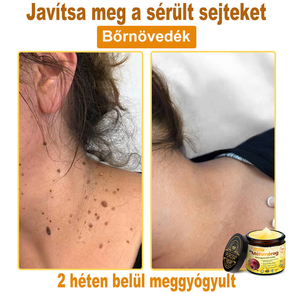 🐝PUROSA® Méhméreg Bőrregeneráló Krém | Teljes körű megoldás makacs bőrproblémákra, például öregedés, ekcéma, hegek és pikkelysömör ellen 🌿✨
