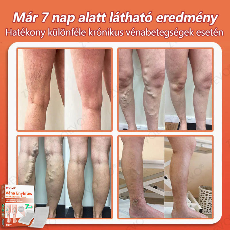 ☘️ Zvoevo® Vein Ease mikro-tűs ápoló tapasz (pókgerincvénák, visszér, duzzanat, fáradt lábak kezelésére)📦