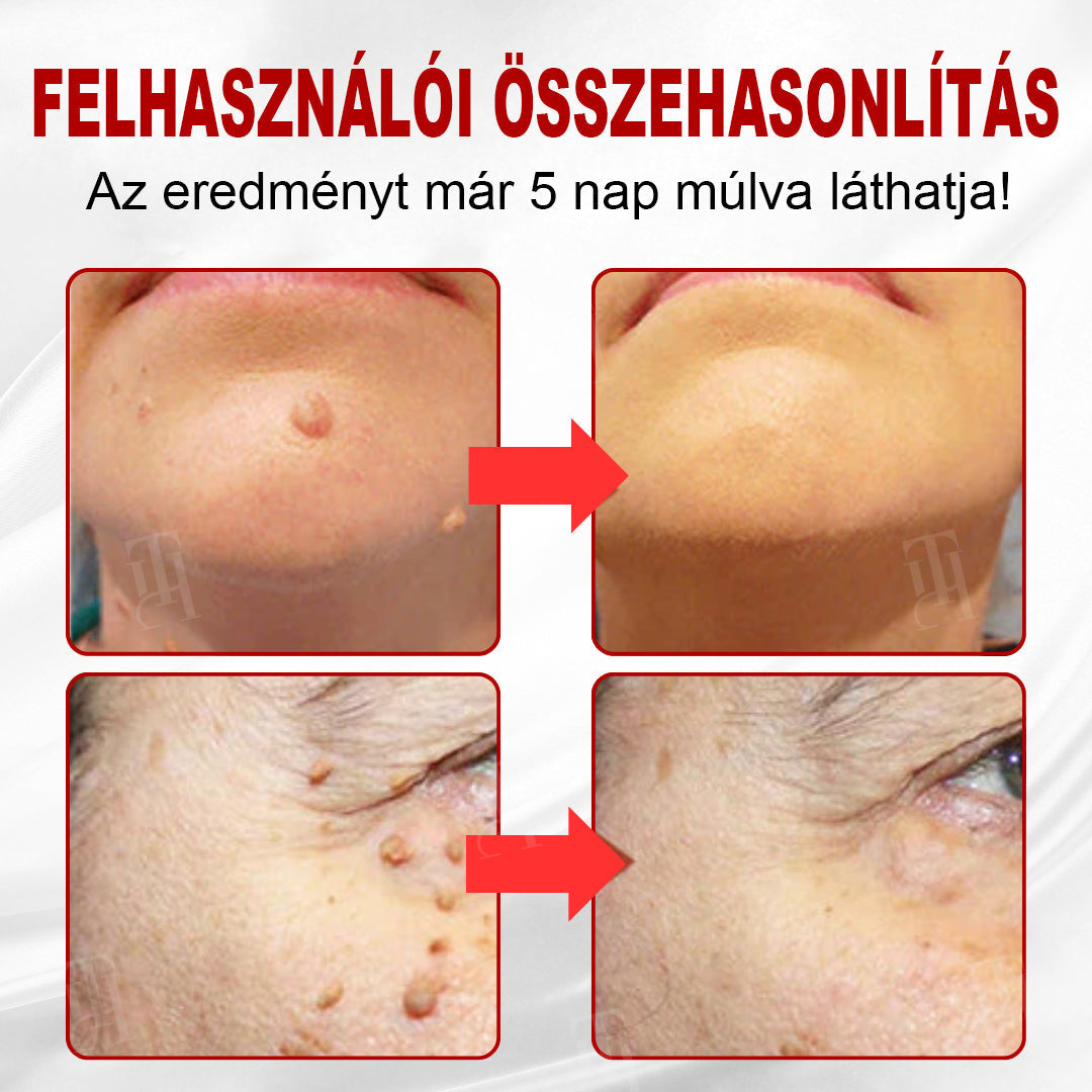 🫧CleraNature® WartAway Pro tapaszo