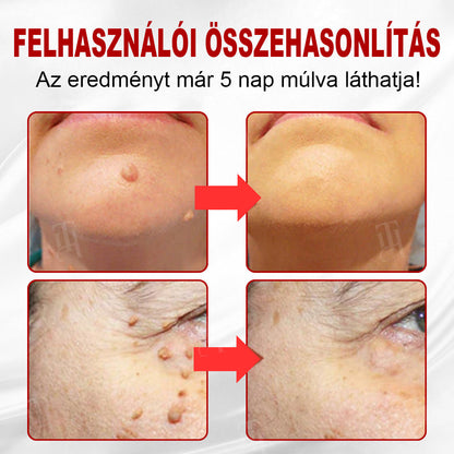 🫧CleraNature® WartAway Pro tapaszo