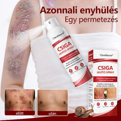 CleraNature® Bálnazsír Spray Viszkető, Hámló Psoriasisra Hajlamos Bőrre⭐