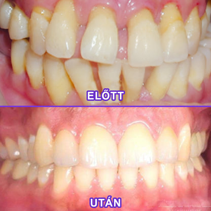 ⭐⭐Laleia® SensiGum Fluoridos Fogkrém