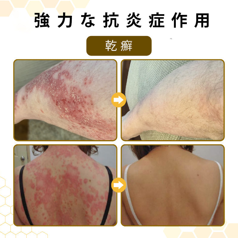 ✨CleraNaure® プソリアスーズ ミツバチ毒配合スキンリストアクリーム