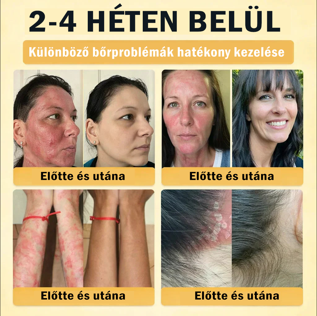 【𝐔𝐭𝐨𝐥𝐬𝐨́ 𝐍𝐚𝐩𝐨𝐬 𝐏𝐫𝐨𝐦ó𝐜𝐢ó 70% 𝐊𝐞𝐝𝐯𝐞́𝐳𝐦é𝐧𝐲】YITOWAY®  𝐌𝐚𝐫𝐡𝐚𝐟ő́𝐭𝐭 & 𝐌𝐞́𝐡𝐦é𝐫𝐠𝐞 𝐉𝐚𝐯í𝐭𝐨́ 𝐊𝐫é𝐦（aknék, ráncok és károsult bőrhez – szteroidmentes）