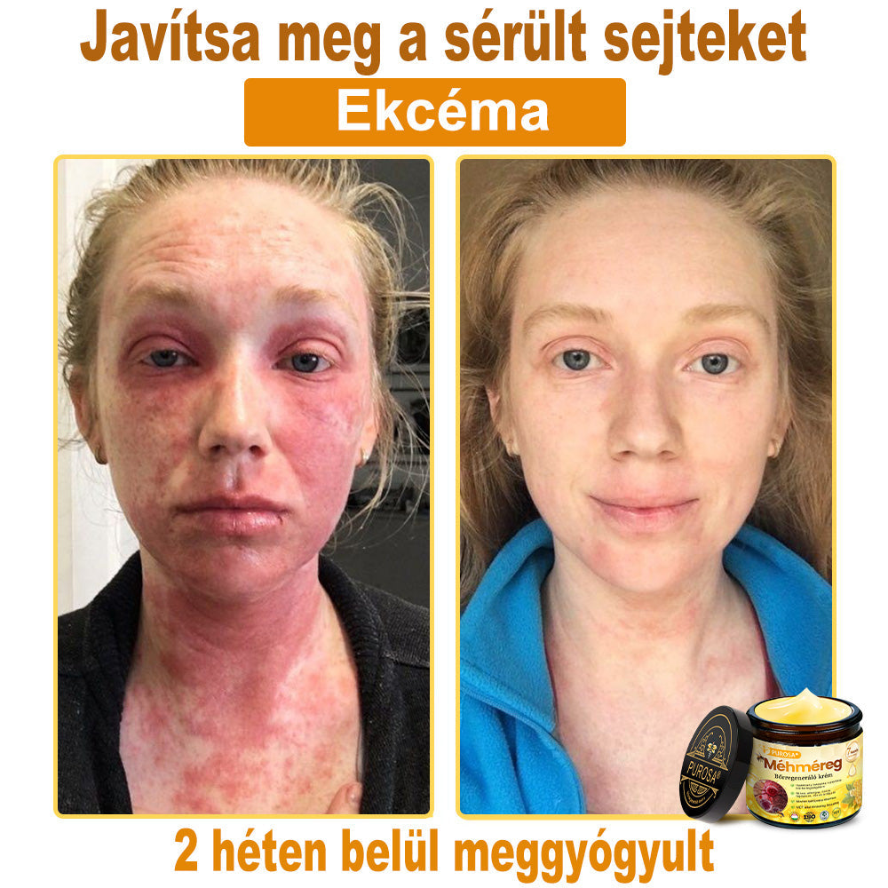 🐝PUROSA® Méhméreg Bőrregeneráló Krém | Teljes körű megoldás makacs bőrproblémákra, például öregedés, ekcéma, hegek és pikkelysömör ellen 🌿✨