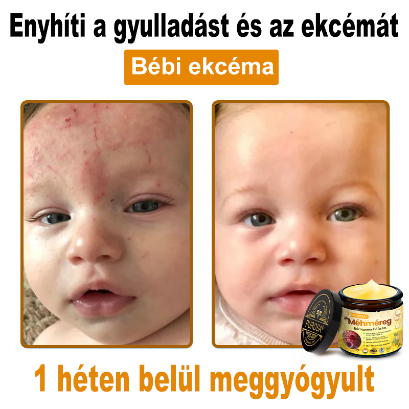 🐝PUROSA® Méhméreg Bőrregeneráló Krém | Teljes körű megoldás makacs bőrproblémákra, például öregedés, ekcéma, hegek és pikkelysömör ellen 🌿✨
