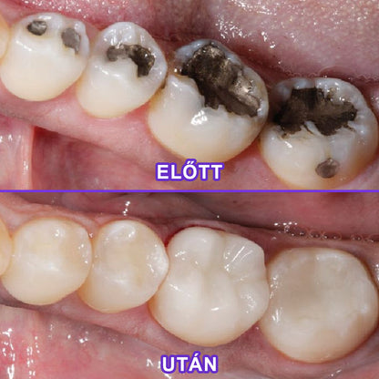 ⭐⭐Laleia® SensiGum Fluoridos Fogkrém