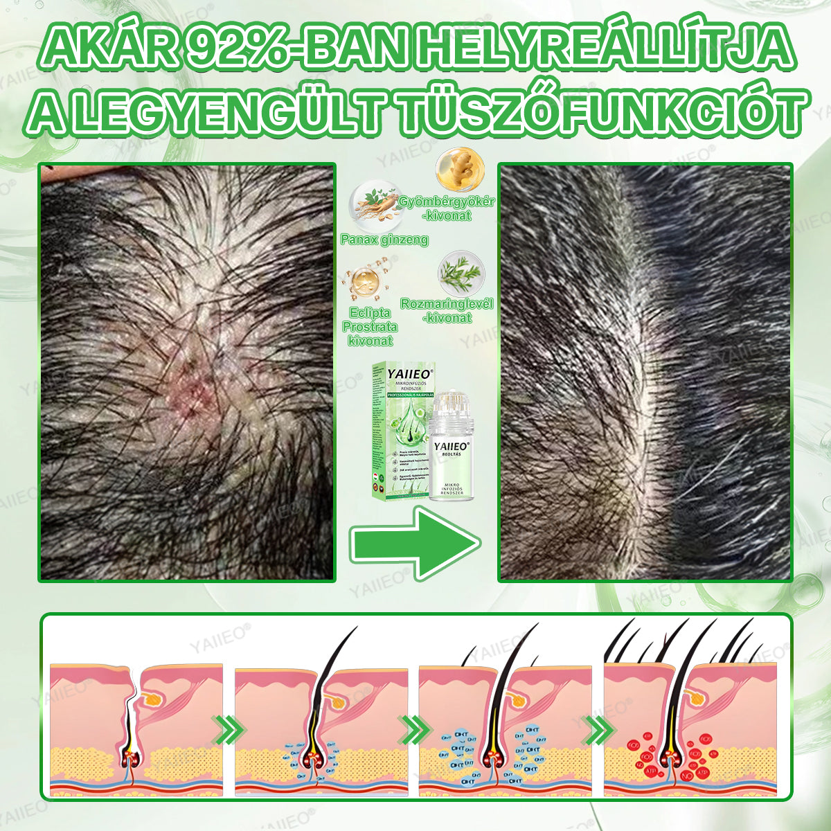 🍍𝐘𝐀𝐈𝐈𝐄𝐎® 𝑭á𝒋𝒅𝒂𝒍𝒐𝒎𝒎𝒆𝒏𝒕𝒆𝒔 𝑴𝒊𝒌𝒓𝒐𝒊𝒏𝒇ú𝒛𝒊ó𝒔 𝑹𝒆𝒏𝒅𝒔𝒛𝒆𝒓 Mélyen ható DHT-blokkolás, hajhagymák újraaktiválása és látható hajnövekedés