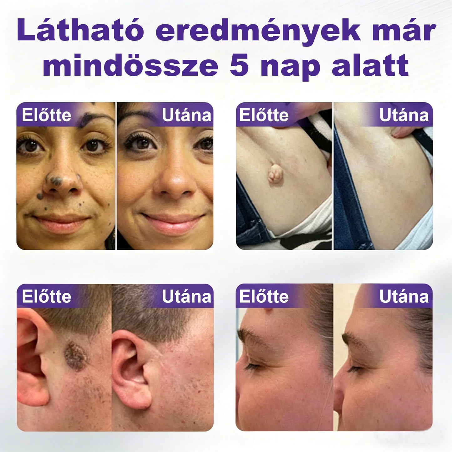 🌟CleraNaure® mikrotűs szemölcs- és anyajegyeltávolító tapasz