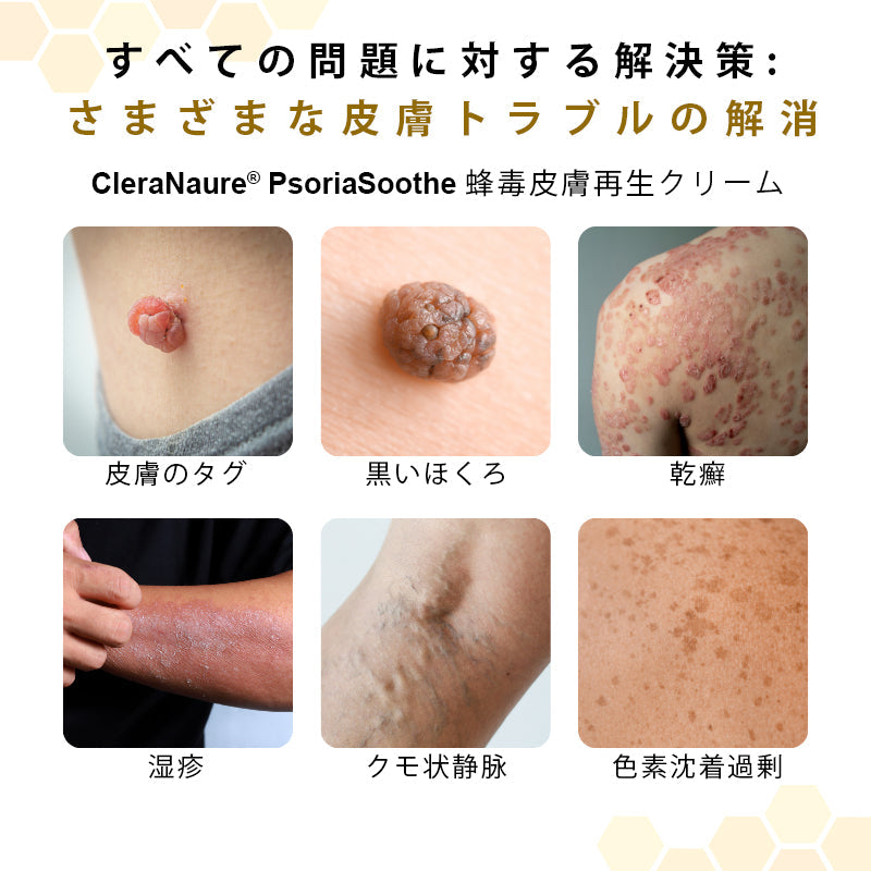 ✨CleraNaure® プソリアスーズ ミツバチ毒配合スキンリストアクリーム