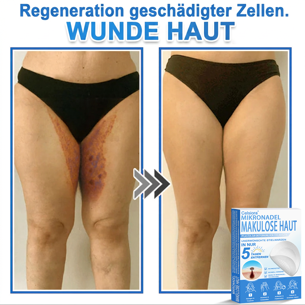 🏆Celsiora® 2-in-1 Mikronadel- & Hydrokolloid-Pflaster | Entferner für erhabene Muttermale, Akne, flache Warzen & Hautanhängsel | Verbessert Falten, Narben & Hautunreinheiten | Unsichtbare Stern-Pickelpflaster für Gesicht & Körper