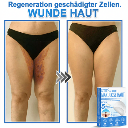 🏆Celsiora® 2-in-1 Mikronadel- & Hydrokolloid-Pflaster | Entferner für erhabene Muttermale, Akne, flache Warzen & Hautanhängsel | Verbessert Falten, Narben & Hautunreinheiten | Unsichtbare Stern-Pickelpflaster für Gesicht & Körper